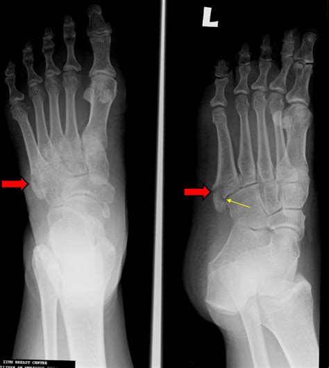 Pseudo Jones Fracture: Heal Faster Naturally