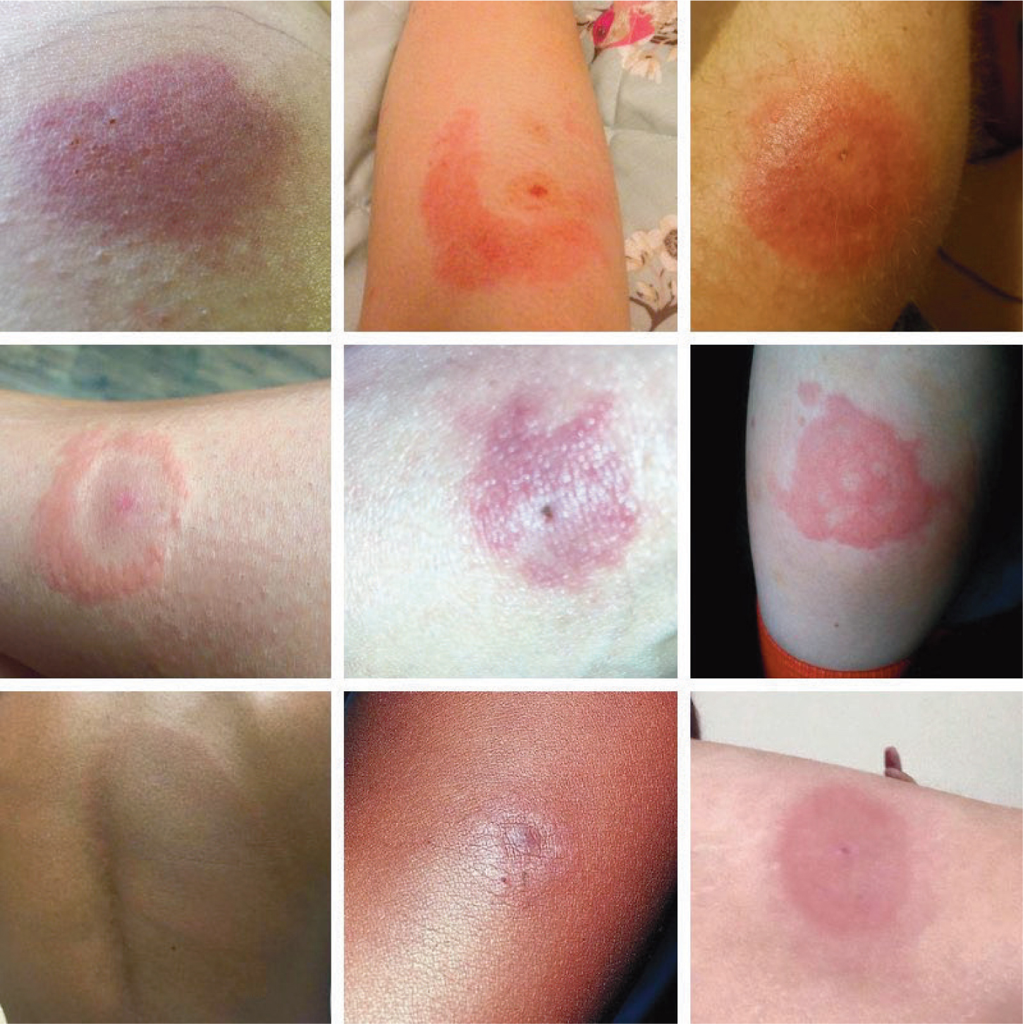 Tick Bite Rash Photos: Identify Symptoms Fast